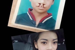 易倍体育app下载-震惊！为声援李亚鹏，一漂亮女孩坦然展示自己唇腭裂手术前后照片